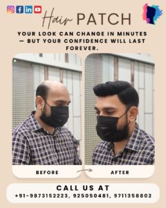 Delhi Hair Fixing offers natural-looking hair patch services for men in Delhi, Dwarka & Patna. Get 100% non-surgical hair replacement with expert care.