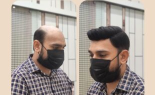 Delhi Hair Fixing offers natural-looking hair patch services for men in Delhi, Dwarka & Patna. Get 100% non-surgical hair replacement with expert care.